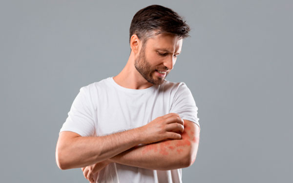 Dermatitis At&oacute;pica: Enfermedad en la piel que afecta la salud mental