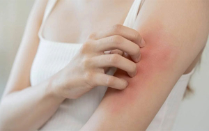 Lo que no logr&oacute; el Detil: cambio clim&aacute;tico con pulgas en l&iacute;nea de extinci&oacute;n